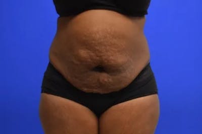 Drainless Tummy Tuck Before & After Gallery - Patient 351509 - Image 1