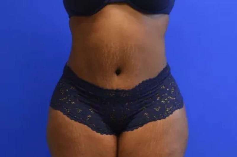 Drainless Tummy Tuck Before & After Gallery - Patient 351509 - Image 2