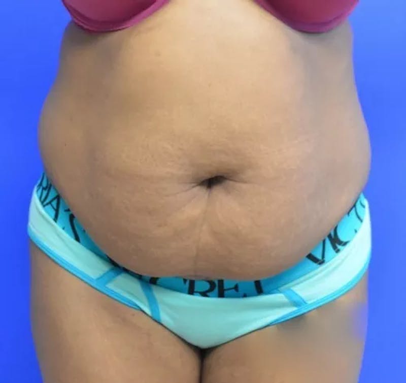 Drainless Tummy Tuck Before & After Gallery - Patient 144540 - Image 1