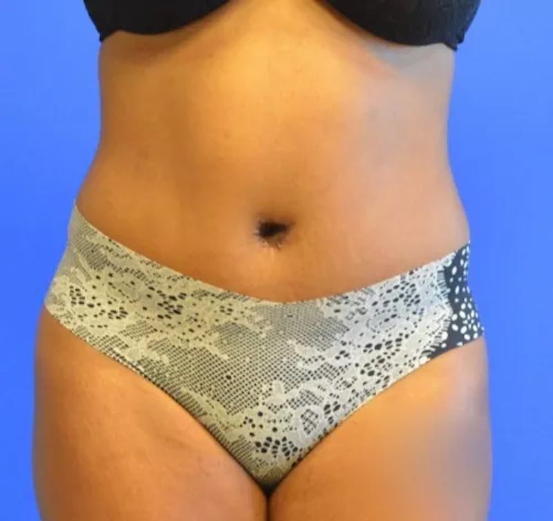 Drainless Tummy Tuck Before & After Gallery - Patient 144540 - Image 2