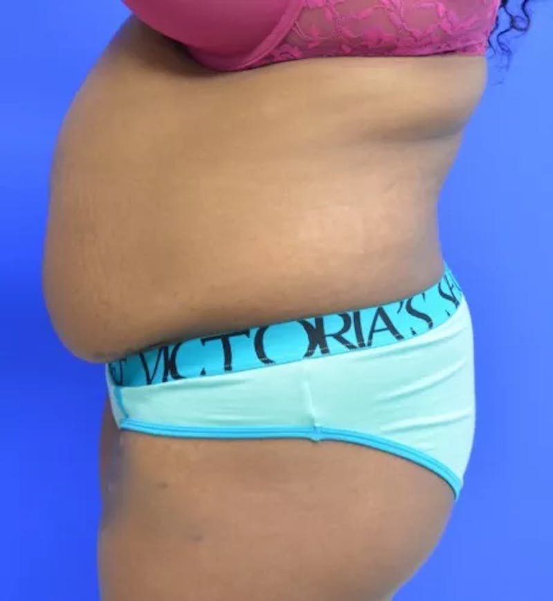 Drainless Tummy Tuck Before & After Gallery - Patient 144540 - Image 7