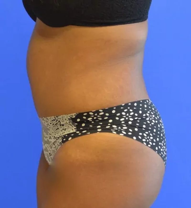Drainless Tummy Tuck Before & After Gallery - Patient 144540 - Image 8