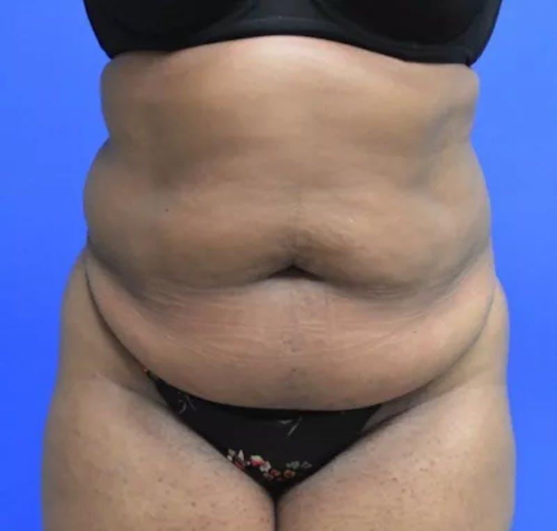 Drainless Tummy Tuck Before & After Gallery - Patient 382030 - Image 1