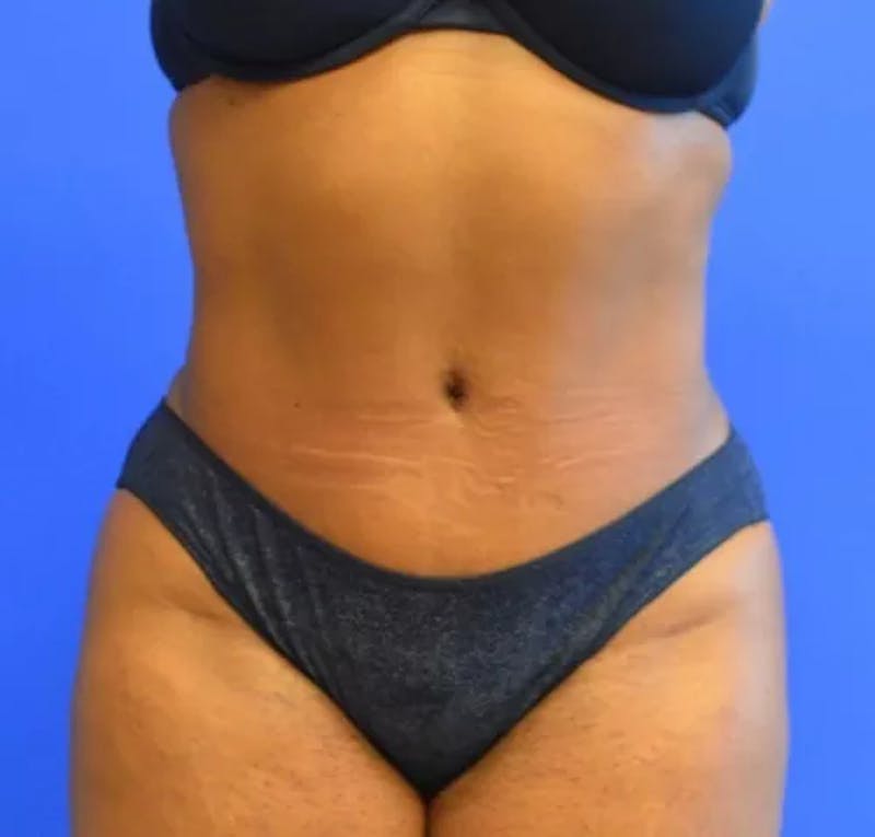 Drainless Tummy Tuck Before & After Gallery - Patient 382030 - Image 2