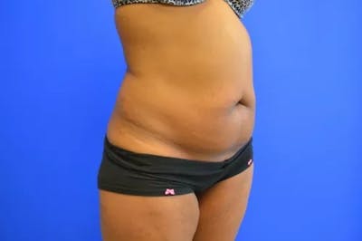 Drainless Tummy Tuck Before & After Gallery - Patient 164519 - Image 1