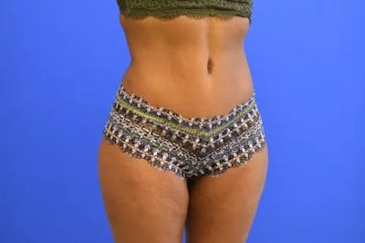 Drainless Tummy Tuck Before & After Gallery - Patient 164519 - Image 2