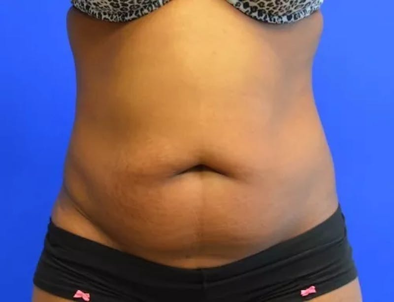Drainless Tummy Tuck Before & After Gallery - Patient 164519 - Image 3