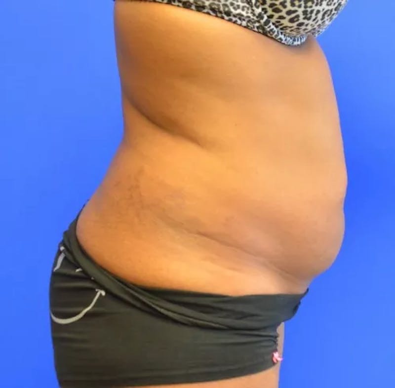 Drainless Tummy Tuck Before & After Gallery - Patient 164519 - Image 5