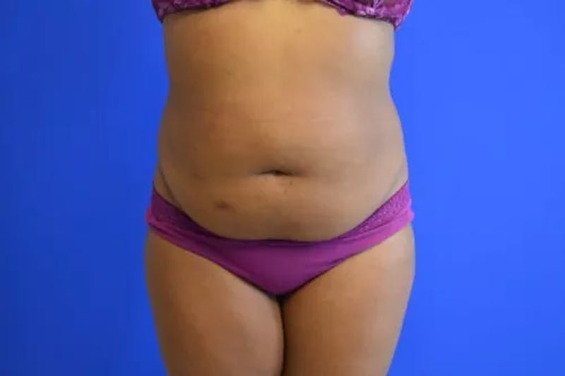 Drainless Tummy Tuck Before & After Gallery - Patient 986316 - Image 1