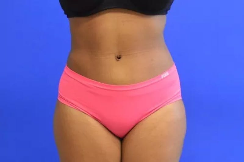 Drainless Tummy Tuck Before & After Gallery - Patient 986316 - Image 2
