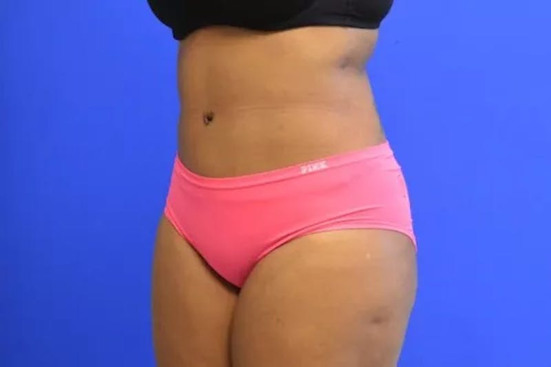 Drainless Tummy Tuck Before & After Gallery - Patient 986316 - Image 4