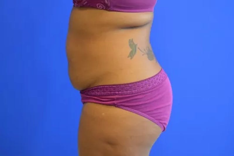 Drainless Tummy Tuck Before & After Gallery - Patient 986316 - Image 5