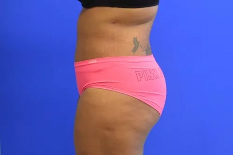 Drainless Tummy Tuck Before & After Gallery - Patient 986316 - Image 6