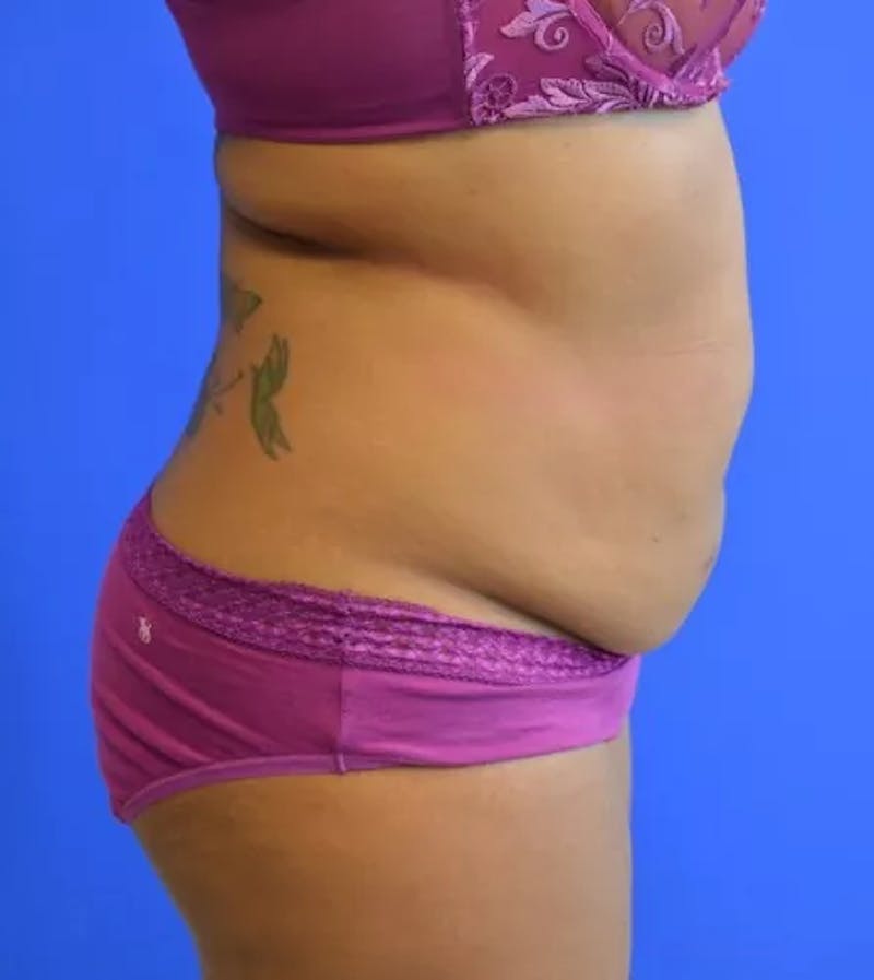 Drainless Tummy Tuck Before & After Gallery - Patient 986316 - Image 7