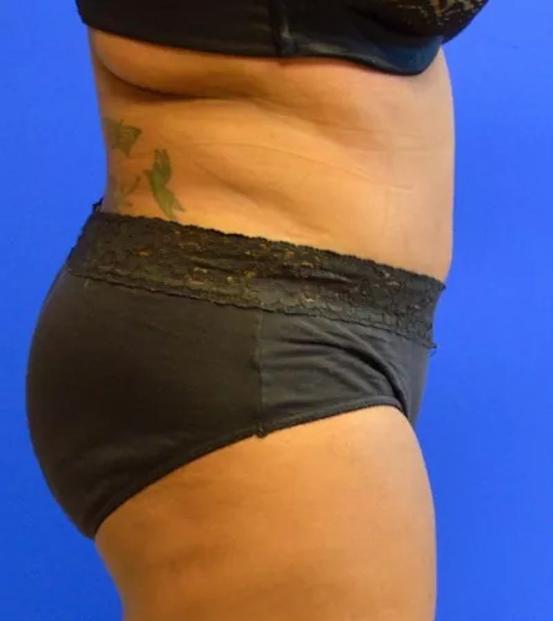 Drainless Tummy Tuck Before & After Gallery - Patient 986316 - Image 8