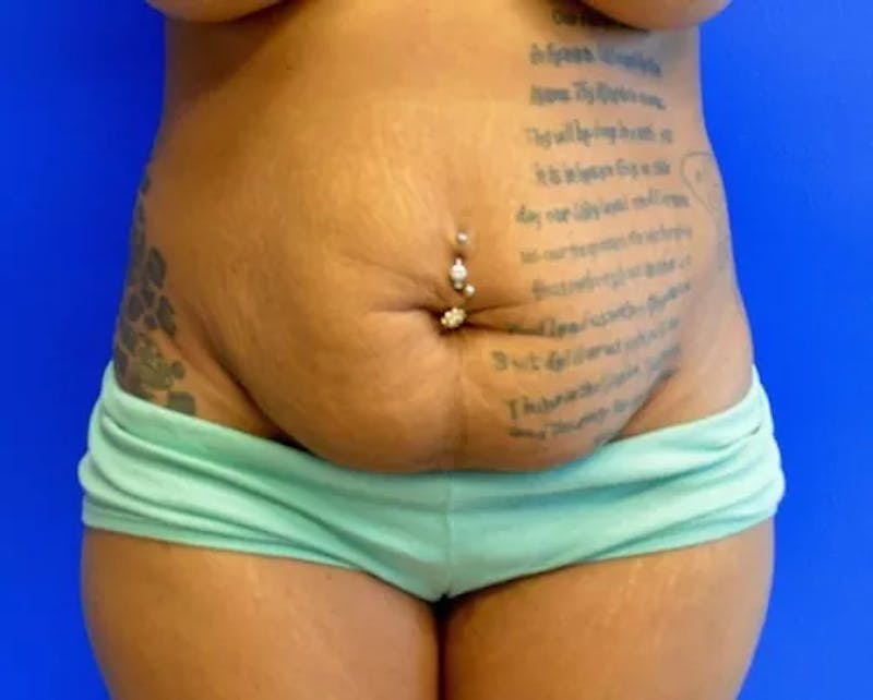 Drainless Tummy Tuck Before & After Gallery - Patient 174732 - Image 1