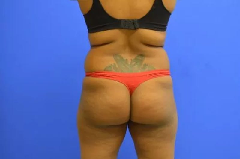 Brazilian Butt Lift Before & After Gallery - Patient 493868 - Image 5