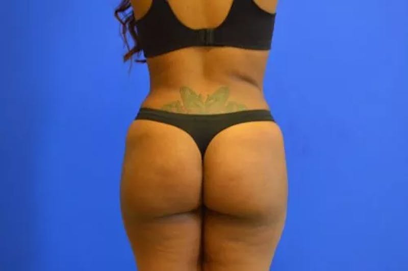 Brazilian Butt Lift Before & After Gallery - Patient 493868 - Image 6