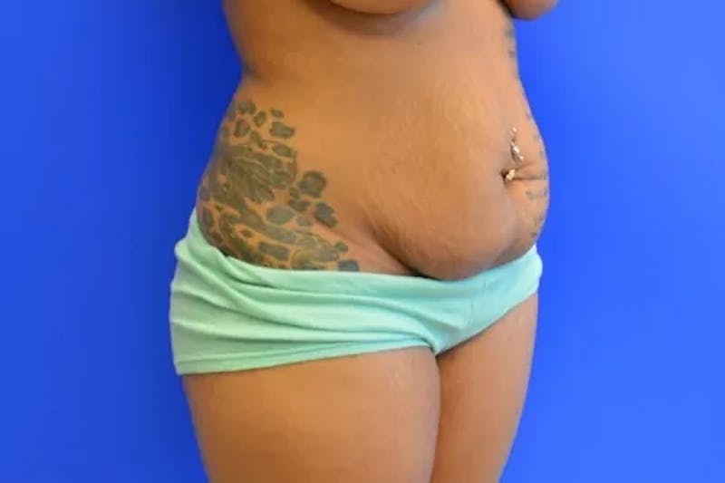 Drainless Tummy Tuck Before & After Gallery - Patient 174732 - Image 3