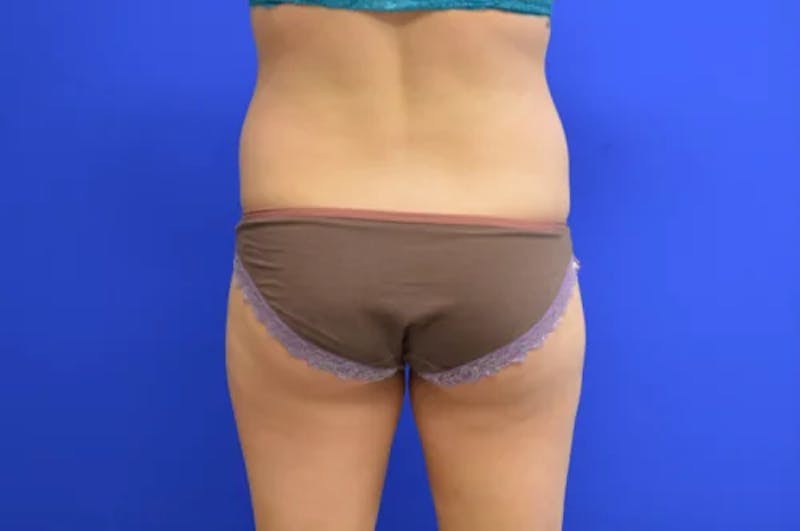 Brazilian Butt Lift Before & After Gallery - Patient 282732 - Image 1