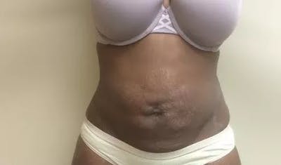 Drainless Tummy Tuck Before & After Gallery - Patient 329340 - Image 1