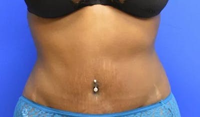 Drainless Tummy Tuck Before & After Gallery - Patient 329340 - Image 2
