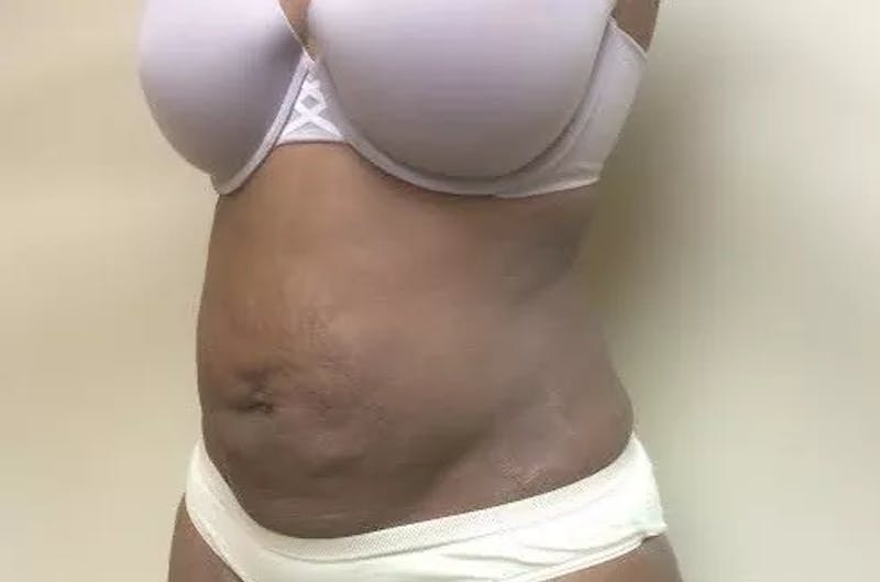Drainless Tummy Tuck Before & After Gallery - Patient 329340 - Image 3