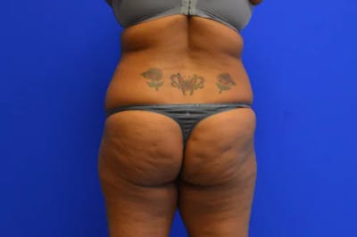 Brazilian Butt Lift Before & After Gallery - Patient 366690 - Image 1