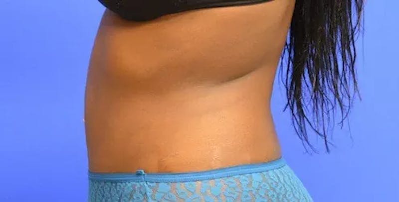 Drainless Tummy Tuck Before & After Gallery - Patient 329340 - Image 6