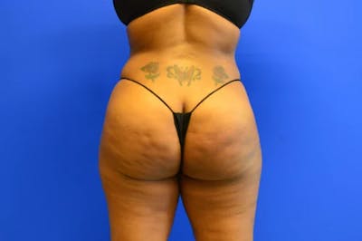 Brazilian Butt Lift Before & After Gallery - Patient 366690 - Image 2