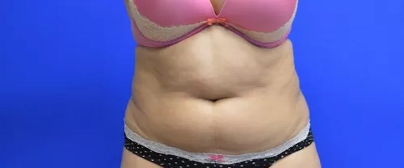 Drainless Tummy Tuck Before & After Gallery - Patient 321901 - Image 1