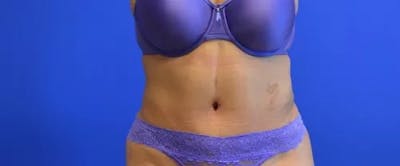 Drainless Tummy Tuck Before & After Gallery - Patient 321901 - Image 2