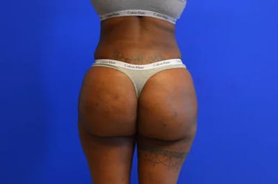 Brazilian Butt Lift Before & After Gallery - Patient 186011 - Image 2