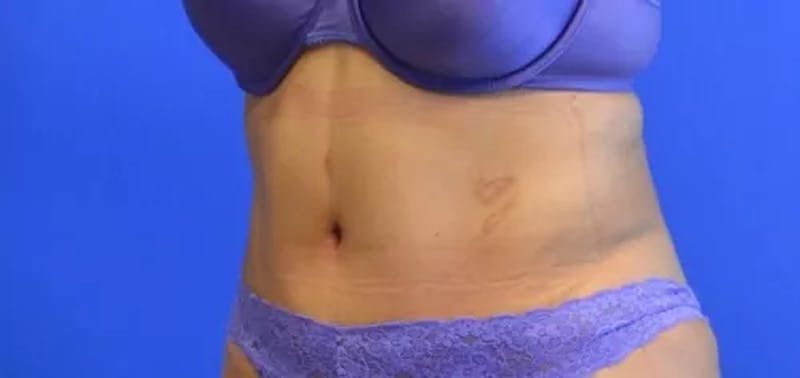 Drainless Tummy Tuck Before & After Gallery - Patient 321901 - Image 4