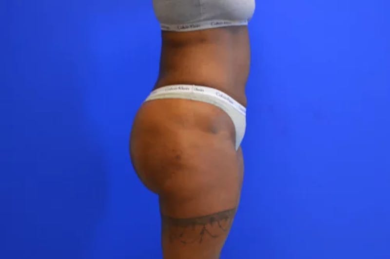 Brazilian Butt Lift Before & After Gallery - Patient 186011 - Image 4