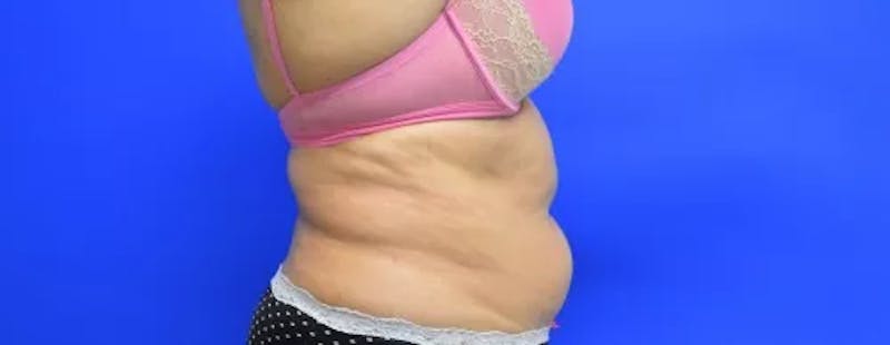 Drainless Tummy Tuck Before & After Gallery - Patient 321901 - Image 5