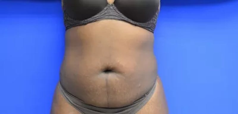 Drainless Tummy Tuck Before & After Gallery - Patient 386436 - Image 1