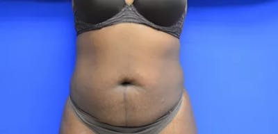 Drainless Tummy Tuck Before & After Gallery - Patient 386436 - Image 1