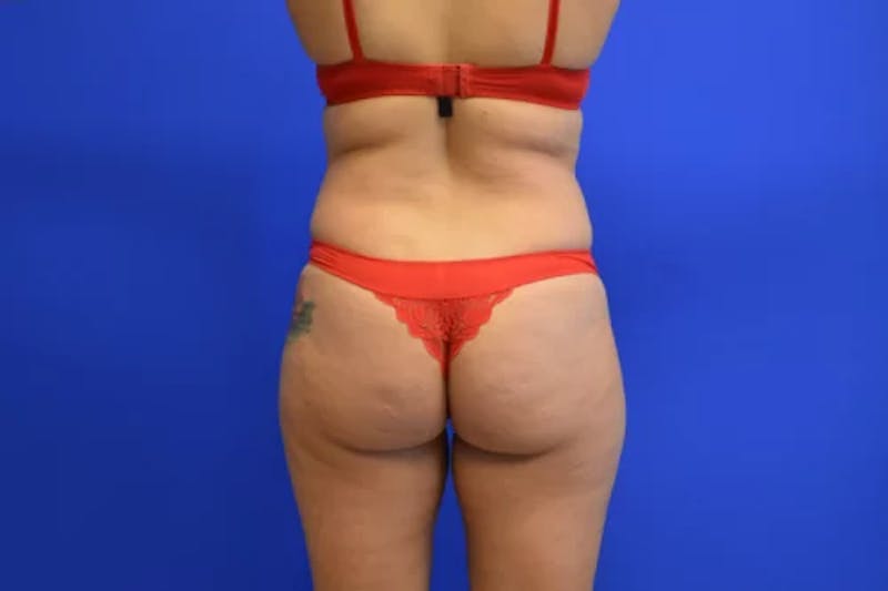 Brazilian Butt Lift Before & After Gallery - Patient 201734 - Image 1