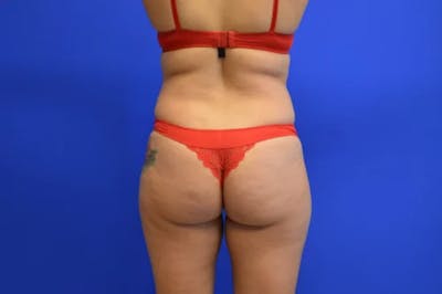 Brazilian Butt Lift Before & After Gallery - Patient 201734 - Image 1