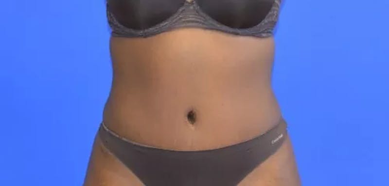 Drainless Tummy Tuck Before & After Gallery - Patient 386436 - Image 2