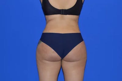 Brazilian Butt Lift Before & After Gallery - Patient 201734 - Image 2