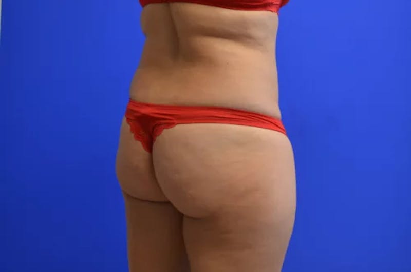 Brazilian Butt Lift Before & After Gallery - Patient 201734 - Image 3