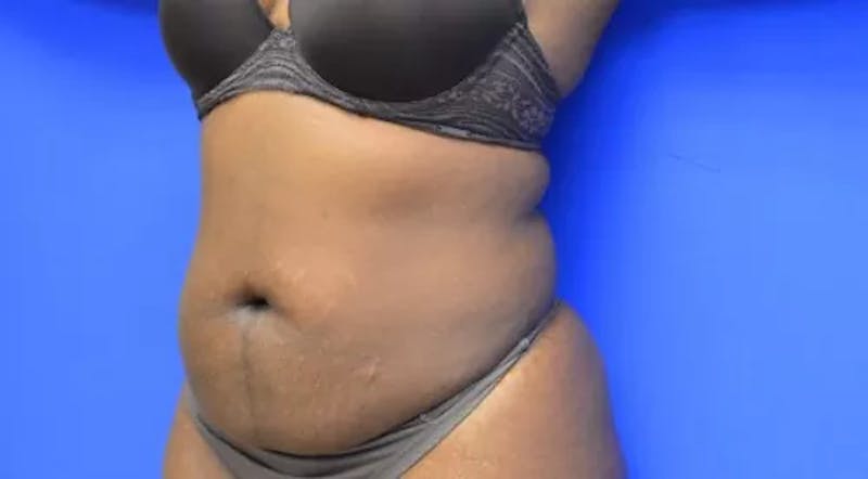 Drainless Tummy Tuck Before & After Gallery - Patient 386436 - Image 5