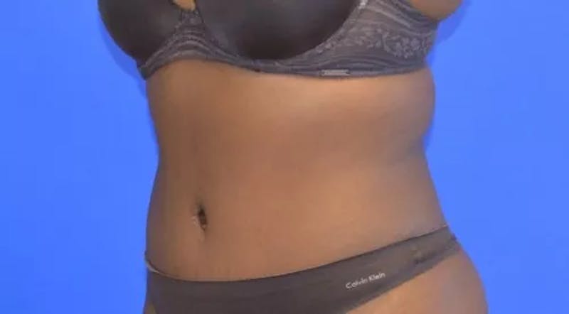 Drainless Tummy Tuck Before & After Gallery - Patient 386436 - Image 6