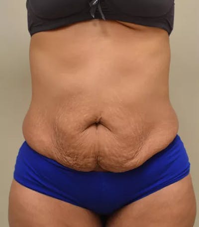 Drainless Tummy Tuck Before & After Gallery - Patient 367985 - Image 1
