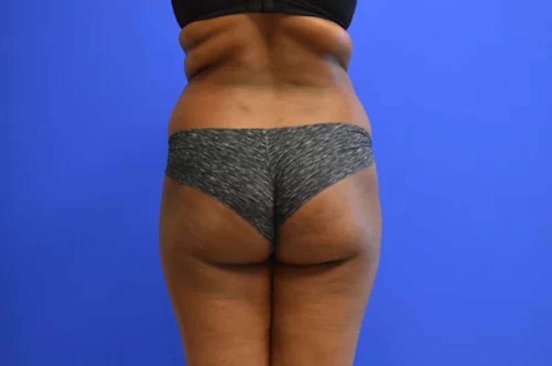 Brazilian Butt Lift Before & After Gallery - Patient 425127 - Image 1