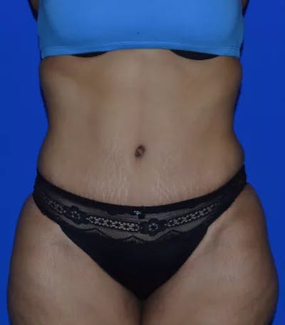 Drainless Tummy Tuck Before & After Gallery - Patient 367985 - Image 2