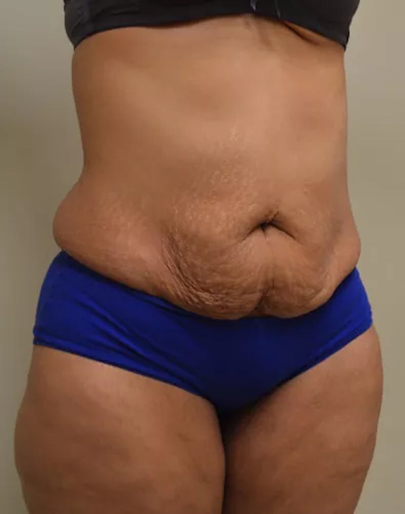 Drainless Tummy Tuck Before & After Gallery - Patient 367985 - Image 3
