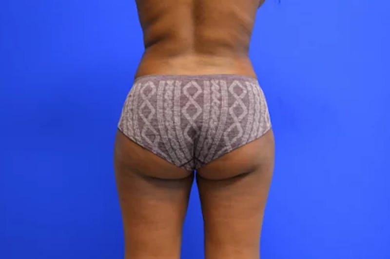 Brazilian Butt Lift Before & After Gallery - Patient 425127 - Image 2